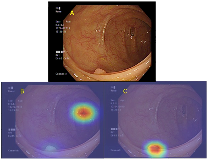 北榮首創ai腸鏡輔助診斷系統多重病灶一次找到 醫療 僑務電子報 北榮首創ai腸鏡輔助診斷系統多重病灶一次找到 醫療 僑務電子報