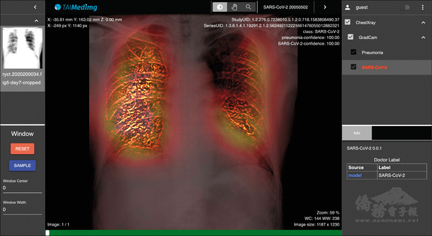 台灣人工智慧實驗室所開發的「武漢肺炎胸腔X光輔助診斷系統」，可透過X光片偵測得知是否有武漢肺炎症狀。（台灣人工智慧實驗室提供）