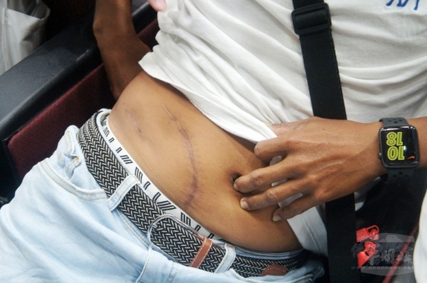 周先生某日晚間潛水時，不慎被水針魚刺到右腹部，經切片培養細菌，確診感染「非結核分枝桿菌」，投藥加上外科清創治療，傷口癒合良好，已恢復正常生活及工作。（臺中榮總提供）