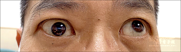 男子因甲狀腺病變導致眼外肌肥厚，造成右眼球轉動困難，出現斜視，無法向上轉動。（自由時報提供）